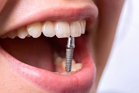 Современная методика имплантации зубов