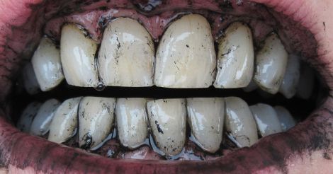Відбілювання зубів активованим вугіллям