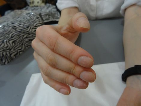 Вигляд пальців, який свідчить про хвороби