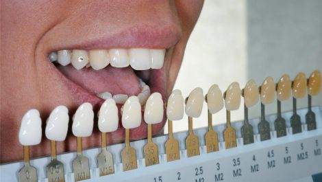 Вплив встановлення вінірів на зуби