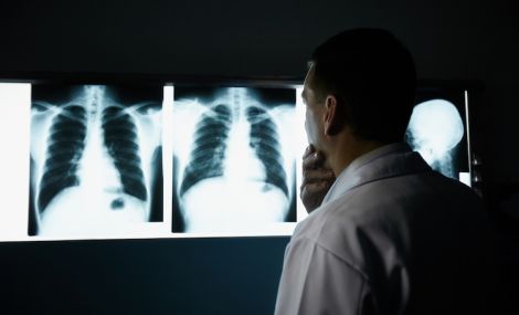 Симптом раку легень