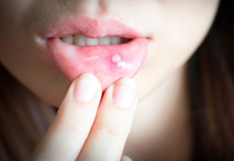 Симптоми раку у вашому роті