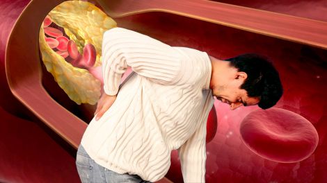 Високий холестерин: біль в попереку може вказувати на небезпечний стан