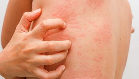 Симптоми раку, які можна переплутати з алергією