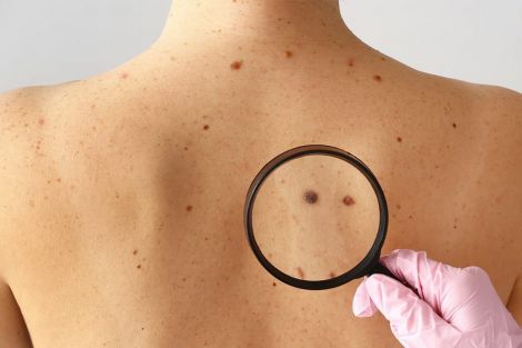 Симптоми раку шкіри: коли йти до лікаря?