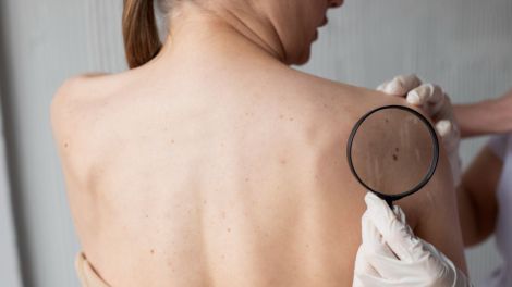 Фахівці розповіли, як не пропустити рак шкіри 