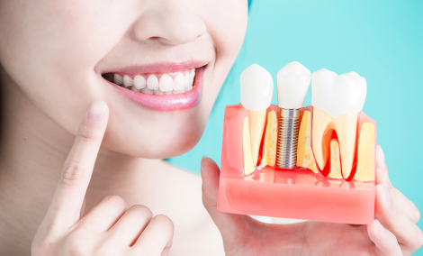 Встановлення зубних імплантів