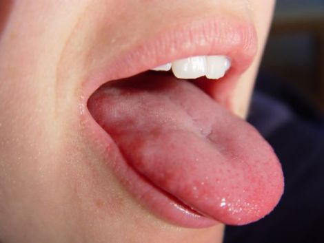 Колір язика та хвороби