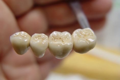 Чи можуть вініри і коронки погіршувати стан зубів?
