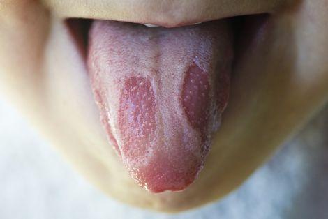 Симптоми раку на язику