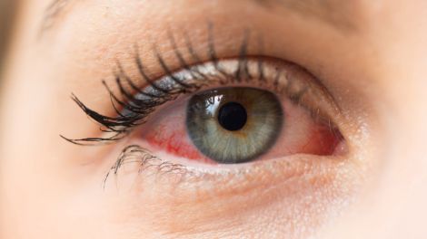 Якість зору: 5 основних причин почервоніння очей