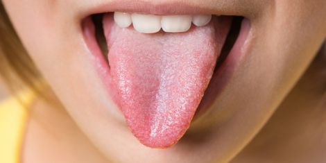 Білий наліт на язику - ознака хвороби