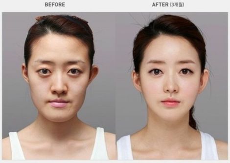 before_and_after_photos_of_korean_plastic_surgery_014.jpg (18.6 Kb)