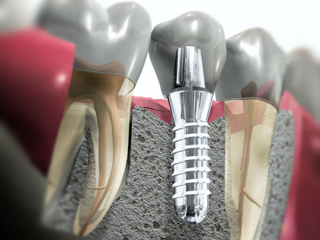 osnovnye-vidy-implantacii-zubov_3.jpg (32.42 Kb)