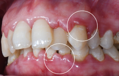 Причини, через які з ясен часто йде кров Причини, через які з ясен часто йде кров