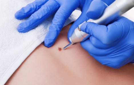 Чому з'являються бородавки і як їх позбутися Чому з'являються бородавки і як їх позбутися