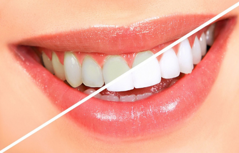 Чи шкідливою є процедура відбілювання зубів Чи шкідливою є процедура відбілювання зубів