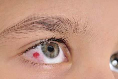 Причини почервоніння очей і способи їх усунення Причини почервоніння очей і способи їх усунення