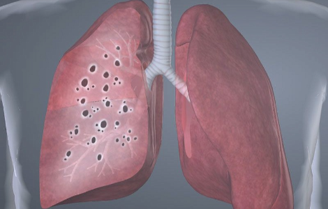 Як зрозуміти, що в людини саркоїдоз Як зрозуміти, що в людини саркоїдоз