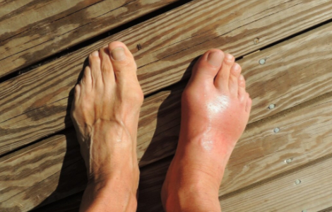 Як проявляються напади подагри Як проявляються напади подагри