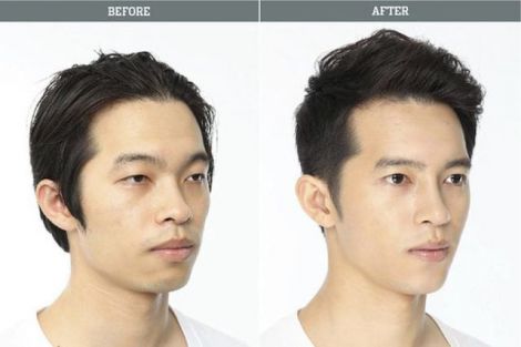 before_and_after_photos_of_korean_plastic_surgery_007.jpg (18.41 Kb)