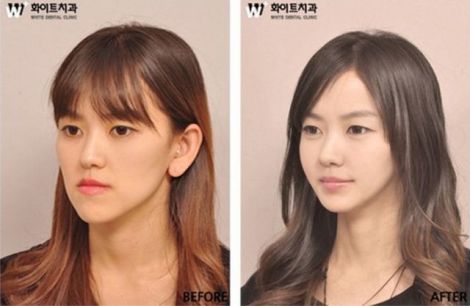 before_and_after_photos_of_korean_plastic_surgery_009.jpg (22.43 Kb)